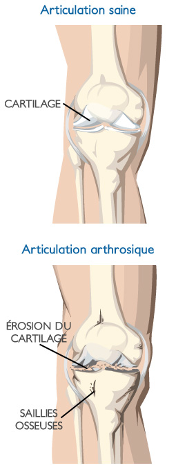 les atteintes de l'arthrose sur le genou